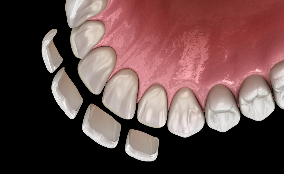 What Are the Different Types of Dental Veneers?